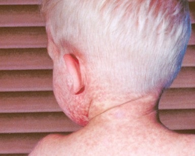 A closeup view of a 2-year-old boy's back with red measles bumps on him.